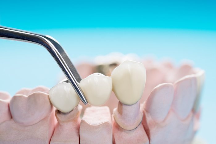 dental bridges in burkburnett, texas